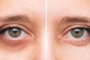 Tanpa kunyit dan minyak zaitun, ini trik atasi mata bengkak dan sembap cuma pakai 1 jenis buah