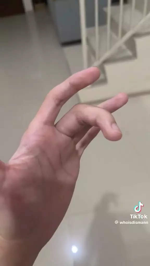 Jari dikira terkilir ternyata autoimun © TikTok
