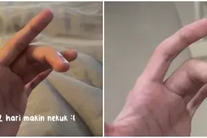 Curhat netizen sendi jari sakit dikira terkilir ternyata autoimun, ceritanya bikin pilu