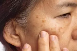 11 Skincare penghilang flek hitam hiperpigmentasi merek lokal di bawah Rp 100 ribu, wajah jadi glowing