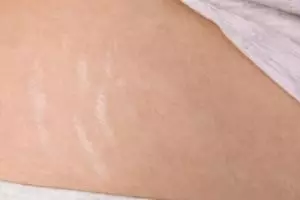 Tanpa scrub kopi, ini trik pudarkan stretch mark pada perut dan paha pakai masker dari 1 jenis buah