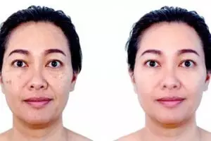 Tanpa kentang, ini trik bikin wajah mulus dan cerah dari flek hitam pakai 1 jenis buah