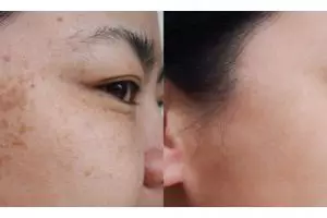 Tanpa masker beras atau madu, ini trik mencerahkan kulit penuh noda hitam pakai 1 jenis buah