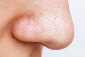 Tanpa putih telur, ini cara angkat komedo hitam dan putih di hidung dengan 1 jenis umbi-umbian