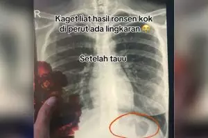 Kaget lihat bentuk aneh di hasil rontgen perutnya, wanita ini malu setelah tahu jawaban dokter