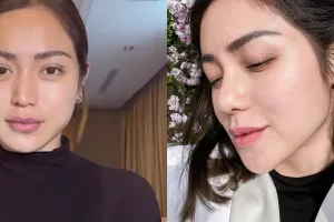 Potret dulu dan kini 5 seleb lakukan operasi hidung di Korea, penampilan Mawar AFI bak bumi dan langit