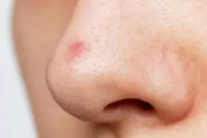 Nggak perlu facial, ini trik bersihkan pori tersumbat penyebab komedo cuma pakai 1 bahan kue