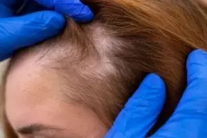 Tak perlu minyak zaitun, ini cara tumbuhkan rambut tipis area depan pakai 1 jenis bumbu dapur