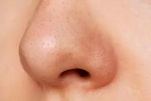 Bukan pakai pore pack, ini cara bersihkan kotoran penyebab komedo di wajah pakai 1 jenis pemanis