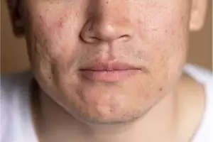 Tanpa serum AHA BHA, ini cara bikin pori-pori besar jadi bersih dan rapat pakai 1 jenis buah