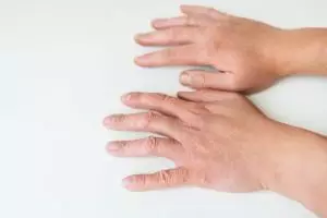 Tak cukup body lotion, ini cara mencerahkan tangan belang akibat panas-panasan pakai 1 jenis minuman