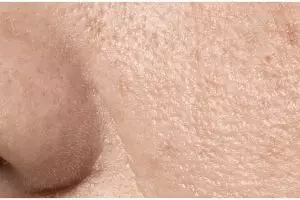 Tanpa produk eksfoliasi, ini trik kecilkan pori-pori di hidung dan dagu pakai 1 bahan rempah