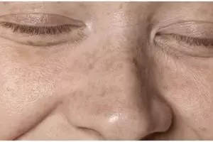 Usia 60 tampak 10 tahun lebih muda, ini cara pudarkan flek hitam pakai krim dari 1 jenis buah