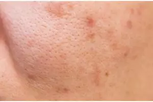 Tanpa dicampur gula, ini cara bersihkan pori-pori wajah agar kulit terlihat mulus pakai 1 jenis tepung