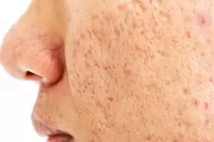 11 Rekomendasi skincare untuk menghilangkan bopeng merek lokal di bawah Rp 150 ribu, wajah jadi mulus