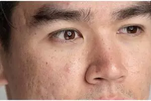 Hasilnya terlihat dalam 7 hari, ini cara cerahkan flek hitam akibat pigmentasi pakai 1 air rendaman