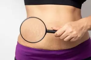 Tanpa petroleum jelly, ini trik pudarkan bekas stretch mark di badan pakai 1 jenis minyak