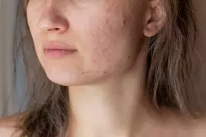 Tak perlu madu, ini trik agar pori-pori wajah rapat dan bebas jerawat pakai 2 jenis daun herbal