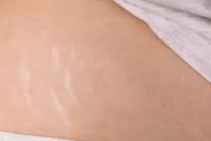 Tak perlu pakai salep, ini trik pudarkan stretch mark membandel pada area perut dengan 1 bahan minuman