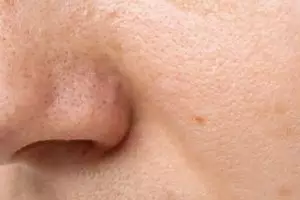 Tak cuma pakai tomat, ini cara kecilkan ukuran pori wajah akibat komedo dengan tambahan 1 jenis rempah