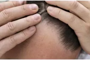 Tanpa pakai hair tonic, ini cara ampuh atasi rambut tipis depan gunakan hair oil dari 1 macam bunga
