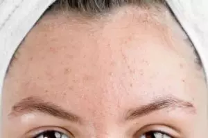 11 Skincare untuk bruntusan di jidat merek lokal di bawah Rp 150 ribu, wajah mulus tak bertekstur