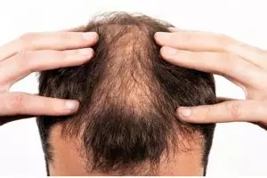 Tanpa ditambah daun kari, ini cara atasi rambut pitak tengah pakai hair oil dari 1 jenis tanaman