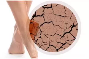 Tanpa dicampur cuka apel, ini cara menghaluskan tumit kaki retak menghitam hanya pakai 1 jenis buah