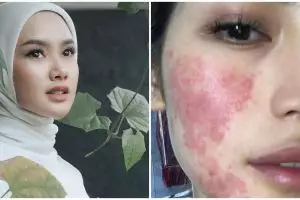 Cerita 9 seleb kena efek samping usai jalani perawatan kecantikan, Cita Citata berujung idap Autoimun