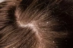 Tanpa lemon dan minyak kelapa, ini cara hempas ketombe basah dan kering pakai 1 jenis daun