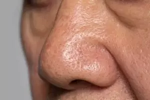 Bukan dioles tomat, ini cara angkat komedo agar pori-pori mengecil pakai 1 jenis buah