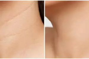 Tanpa gunakan madu dan oatmeal, ini cara merontokkan daki hitam di leher pakai 1 jenis tanaman