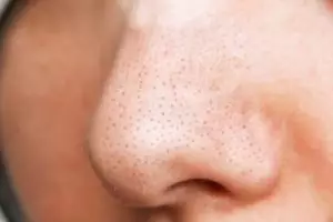 Wajah bebas komedo tanpa lemon, ini cara bikin scrub atasi pori-pori tersumbat pakai 1 jenis pemanis