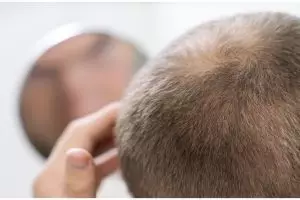 Bukan dicampur teh hijau, ini cara tingkatkan pertumbuhan rambut botak tengah hanya pakai 1 jenis buah