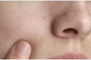 Tanpa madu, ini cara bersihkan pori-pori kulit agar wajah bebas dari jerawat pakai 1 jenis minuman