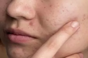 11 Rekomendasi skincare untuk fungal acne merek lokal di bawah Rp 150 ribu, wajah glowing antijerawat