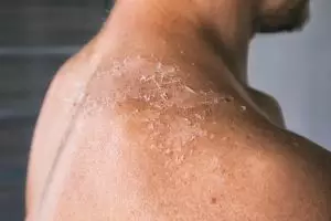 Tak hanya aloe vera, ini trik bikin kulit kering bersisik jadi lembap seharian pakai 2 jenis minyak