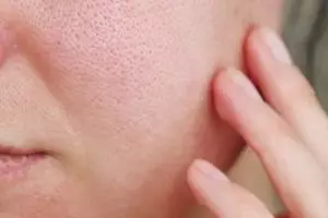 Tak perlu kentang, ini cara kecilkan pori-pori berminyak agar bebas jerawat pakai 1 jenis minuman