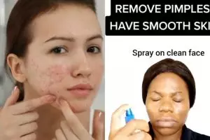 Tanpa bubuk matcha, ini trik bikin toner rawat pori-pori dari jerawat pakai 1 tanaman herbal