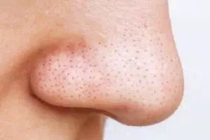 11 Skincare untuk mengecilkan pori-pori hidung merek lokal di bawah Rp 150 ribu, wajah jadi glowing