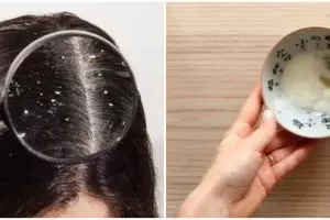 Bukan pakai scrub cuka apel, ini trik atasi ketombe agar tak semakin banyak dengan 1 jenis buah