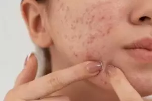 11 Rekomendasi skincare breakout merek lokal harga di bawah Rp 150 ribu, atasi jerawat dan kemerahan