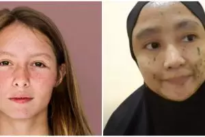 Trik pudarkan bintik hitam pada wajah cuma pakai masker dari 1 jenis daun, bikin kulit auto glowing