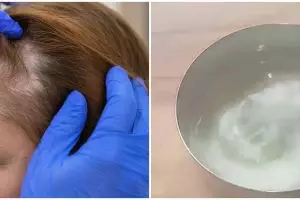 Tak hanya minyak argan, ini cara mengatasi rambut tipis depan pakai hair mask dari 1 bahan dapur