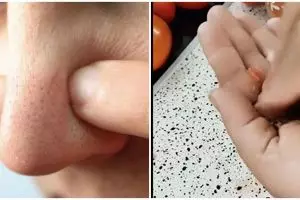 Tanpa produk scrub, ini cara atasi wajah berkomedo agar pori-pori bersih pakai masker 1 bahan dapur