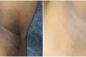 Kulit kembali jadi glowing, ini trik mencerahkan ketiak yang hitam pekat pakai 1 bumbu dapur