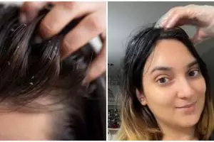 Tanpa sampo khusus, ini cara atasi ketombe dan kulit kepala mengelupas cuma pakai 2 bahan dapur