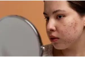 Tanpa gel aloe vera, ini trik hempas noda gelap wajah akibat pigmentasi pakai 2 bahan dapur