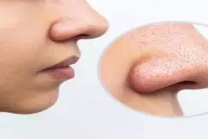 Bersih tanpa porepack, ini trik kurangi komedo agar pori-pori kembali rapat pakai 1 jenis minuman