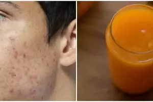 Tak diolesi acne cream, ini cara hilangkan jerawat & bekasnya dari dalam pakai jus dari 1 bahan masak